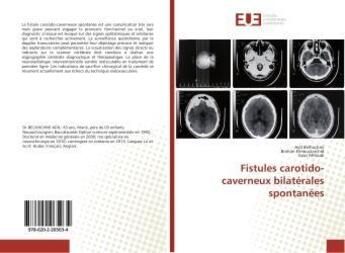 Couverture du livre « Fistules carotido-caverneux bilaterales spontanees » de Belhachmi Adil aux éditions Editions Universitaires Europeennes