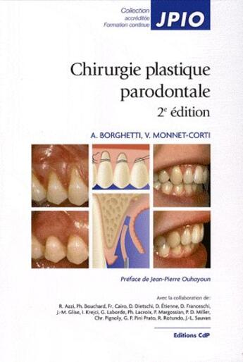 Couverture du livre « Chirurgie plastique parodontale (2ème édition) » de Borghetti aux éditions Cahiers De Protheses
