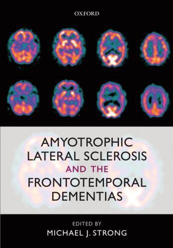 Couverture du livre « Amyotrophic Lateral Sclerosis and the Frontotemporal Dementias » de Michael J Strong aux éditions Oup Oxford