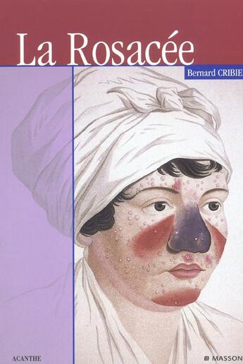 Couverture du livre « La rosacee » de Bernard Cribie aux éditions Elsevier-masson