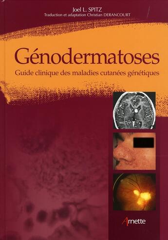 Couverture du livre « Génodermatoses ; guide clinique des maladies cutanées génétiques » de Joel L. Spitz aux éditions Arnette