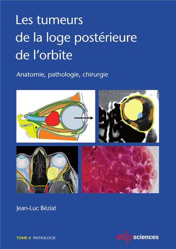 Couverture du livre « Les tumeurs de la loge postérieure de l'orbite t.2 ; anatomie, pathologie, chirurgie » de Jean-Luc Beziat aux éditions Edp Sciences