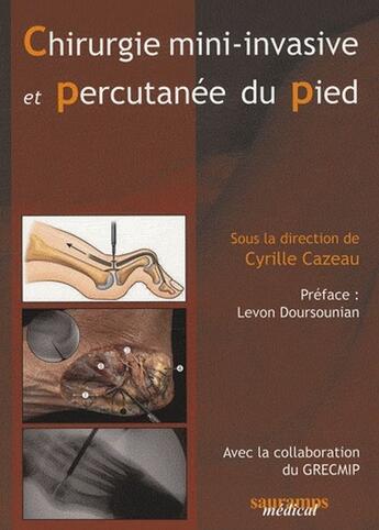Couverture du livre « Chirurgie mini invasive et percutanée du pied » de Cyrille Cazeau aux éditions Sauramps Medical