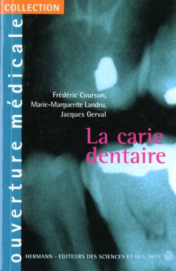 Couverture du livre « La carie dentaire » de Courson Frederi aux éditions Hermann