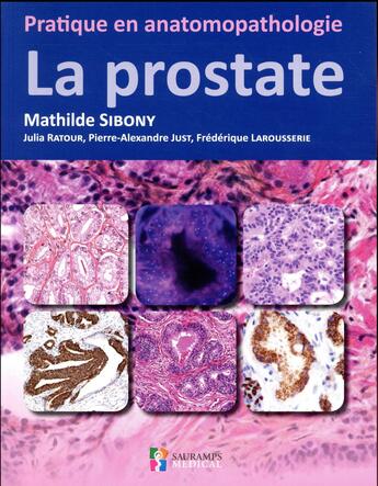 Couverture du livre « Pratique en anatomopathologie : la prostate » de Mathilde Sibony aux éditions Sauramps Medical