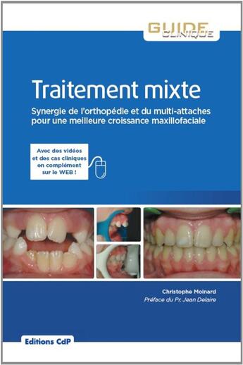 Couverture du livre « Traitement mixte ; synergie de l'orthopédie et du multi-attaches pour une meilleure croissance maxillo-faciale » de Christophe Moinard aux éditions Cahiers De Protheses