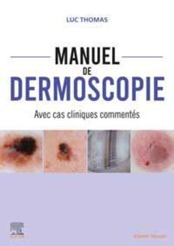 Couverture du livre « Manuel de dermoscopie : avec cas cliniques commentés » de Luc Thomas aux éditions Elsevier-masson