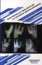 Couverture du livre « Prothèses et implants de la trapézo métacarpienne » de Bruno Lussiez aux éditions Sauramps Medical